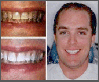 Teeth Whitening Slide 1