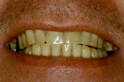 Teeth Whitening Slide 10