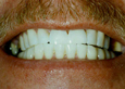 Teeth Whitening Slide 11