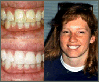 Teeth Whitening Slide 13