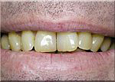 Teeth Whitening Slide 14