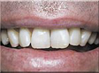 Teeth Whitening Slide 15