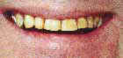 Teeth Whitening Slide 17