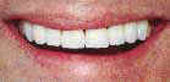 Teeth Whitening Slide 18