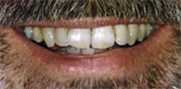 Teeth Whitening Slide 2