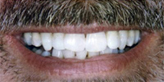Teeth Whitening Slide 3