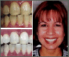 Teeth Whitening Slide 4