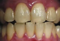 Teeth Whitening Slide 5