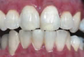 Teeth Whitening Slide 6