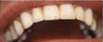Teeth Whitening Slide 7