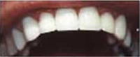Teeth Whitening Slide 8