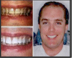 teeth whitening rotator