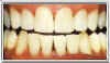 teeth whitening aging after
