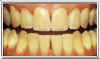teeth whitening aging before