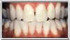 teeth whitening genetic after