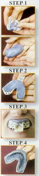 Teeth Whitening Impressions Steps