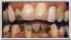 teeth whitening smoking before