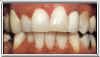 teeth whitening smoking after