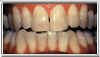 Genetic Stains Before Applying Teeth Whitening Gel by Brighter Image
